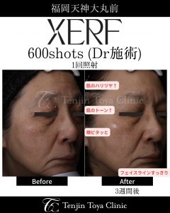 切らない、痛くない、たるみ治療【ザーフ】症例