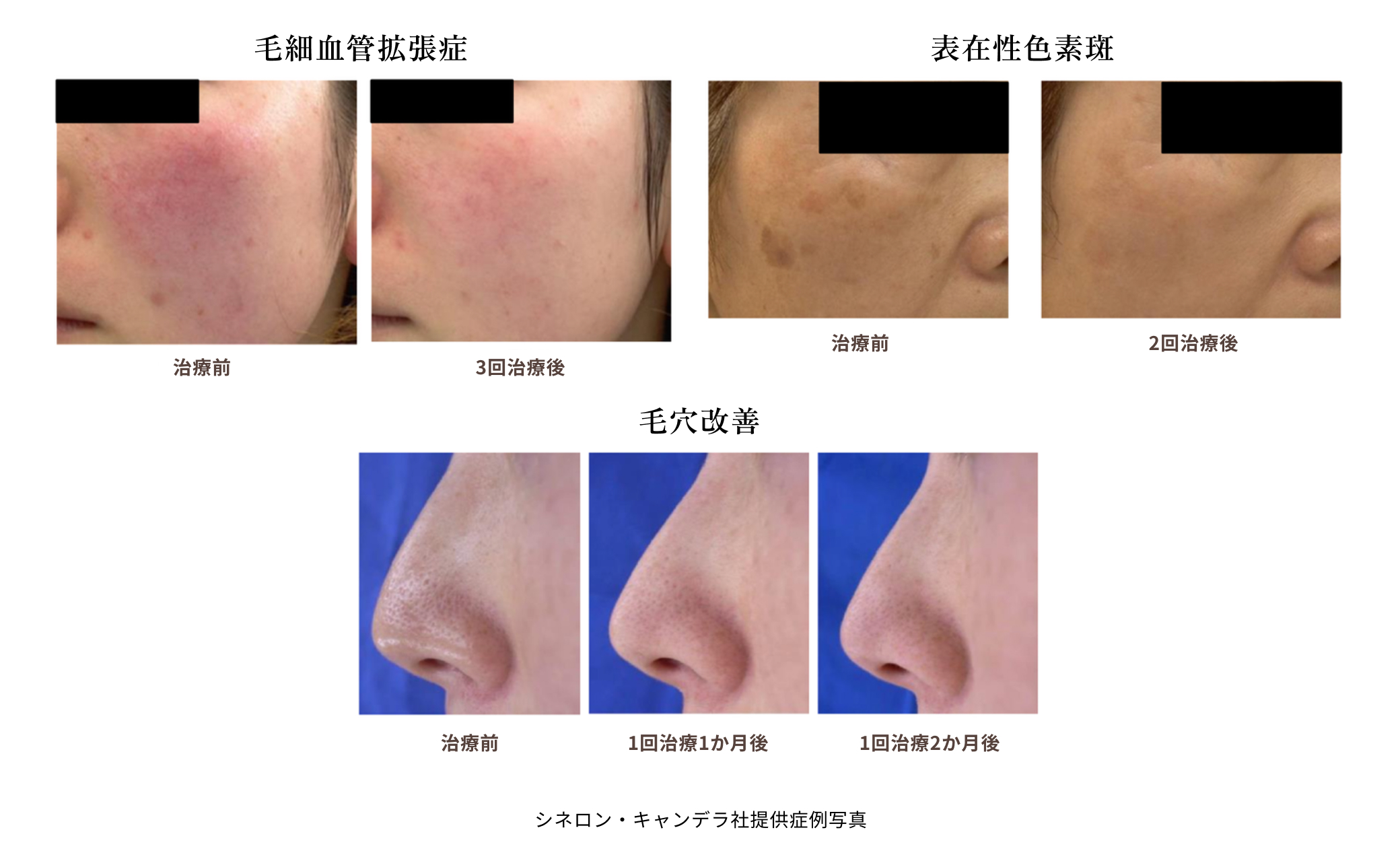 シネロン・キャンデラ社提供症例写真