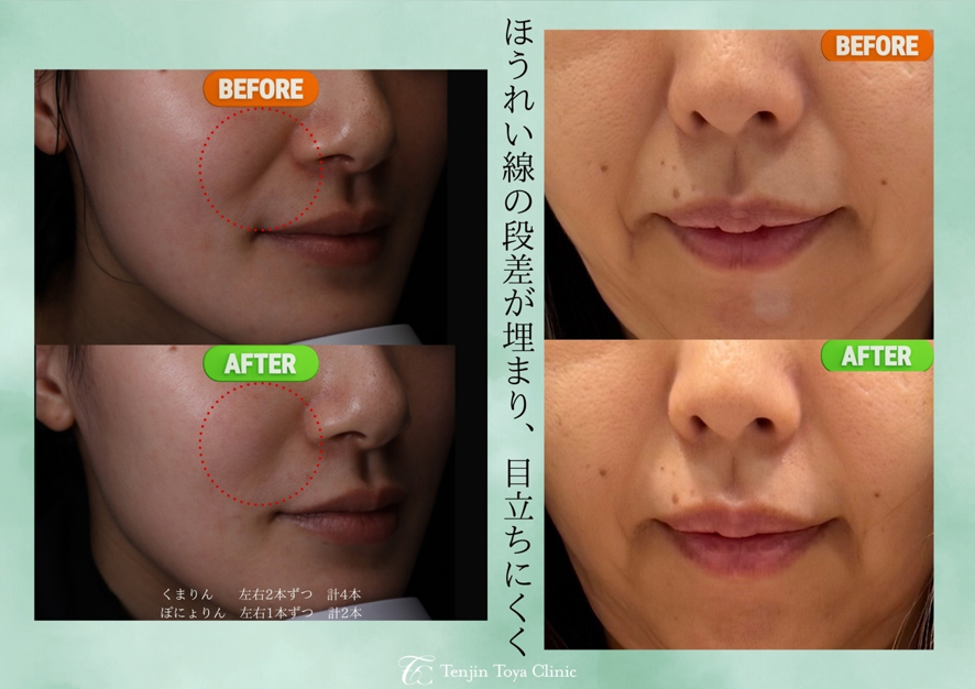 ぽにょりん・くまりんbeforeafter